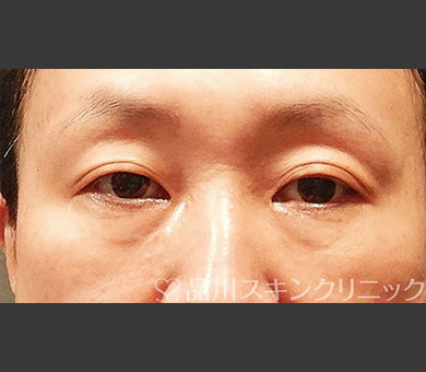 切らないクマ取り 症例写真