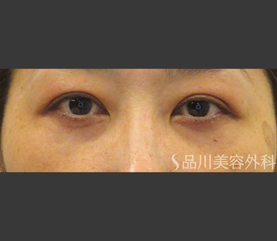 スーパーナチュラル目の下のたるみ取り 症例写真