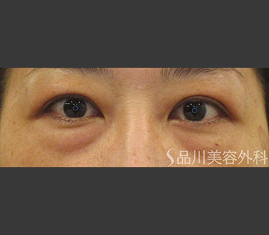 スーパーナチュラル目の下のたるみ取り 症例写真