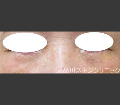 スーパーナチュラル目の下のたるみ取り 症例写真