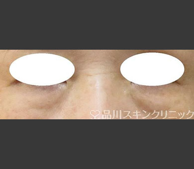 スーパーナチュラル目の下のたるみ取り 症例写真