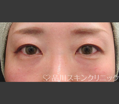 ヒアルロン酸注射（レスチレン®リド） 症例写真