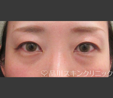 ヒアルロン酸注射（レスチレン®リド） 症例写真