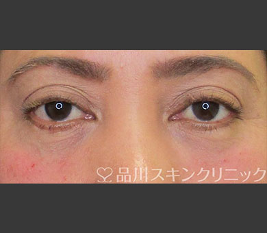 ヒアルロン酸注射（レスチレン®リド） 症例写真