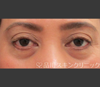 ヒアルロン酸注射（レスチレン®リド） 症例写真