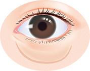 むくみがあり、疲れた顔に見える