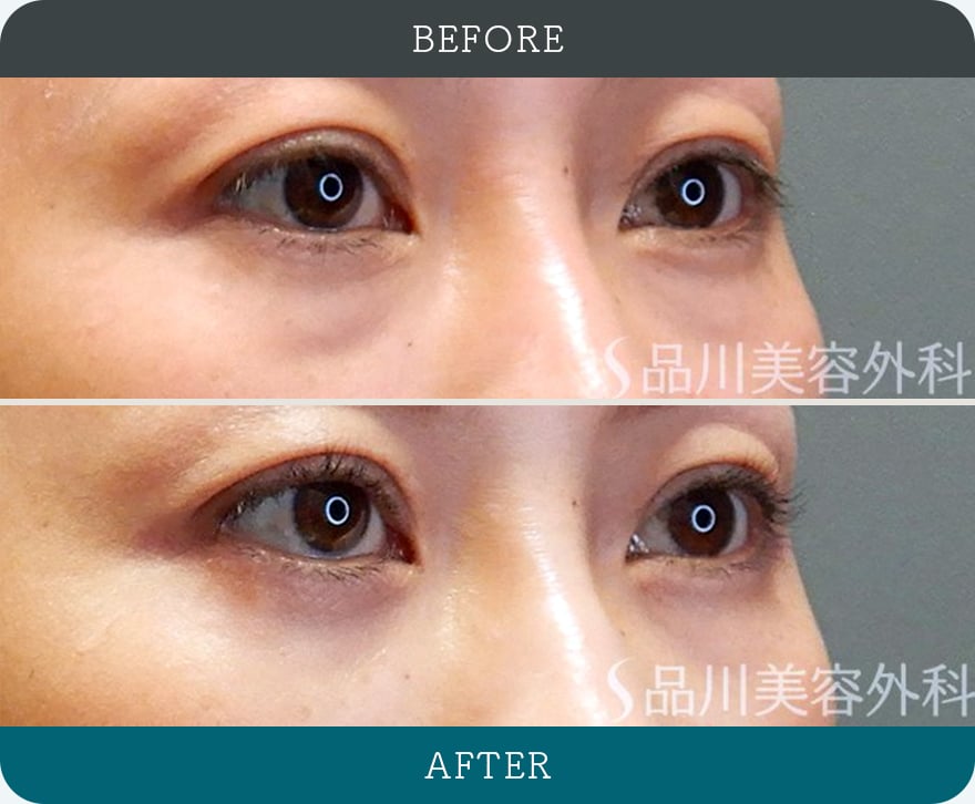 切らないクマ取り 症例写真