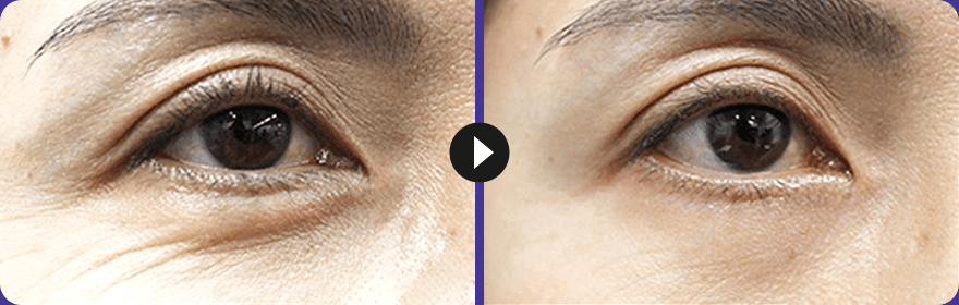 美肌注射の症例写真