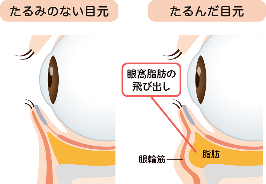 目の下のクマ・たるみができる原因