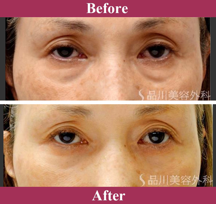 目の下のふくらみ取り 症例写真【画像】