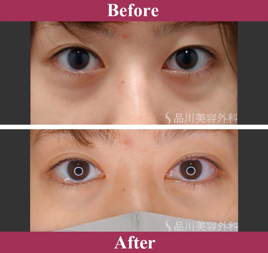 目の下のふくらみ取り 症例写真【画像】