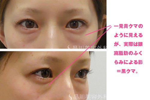 根気よく美白…茶クマの解消法は中と外から