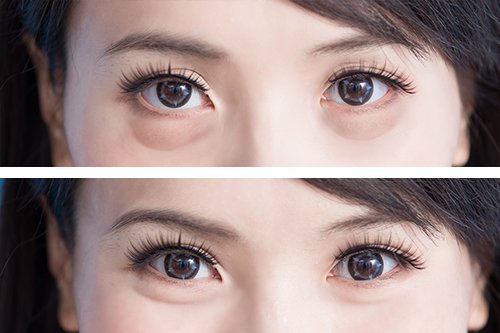 目の下のクマ消しに！原因・タイプ別対策・治療法