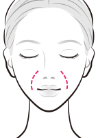 ヒアルロン酸を注入でほうれい線を改善【画像】
