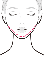 1日脂肪取り®顔痩せ注射でアゴのラインをスッキリ【画像】