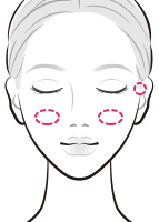 ヒアルロン酸を注入でホホや耳前部を改善【画像】