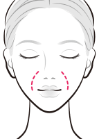 ヒアルロン酸を注入でほうれい線を改善【画像】