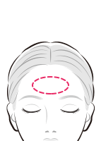 ヒアルロン酸注入で額に丸みを出す【画像】