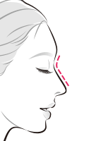 ヒアルロン酸注入で鼻筋を高く【画像】