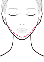 1日脂肪取り®顔痩せ注射で余分な脂肪を軽減【画像】