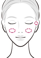 ヒアルロン酸を注入でホホや耳前部にボリュームを【画像】