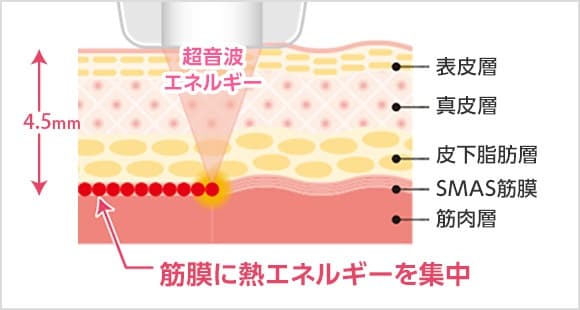 ダブロは「SMAS筋膜」にアプローチするマシン