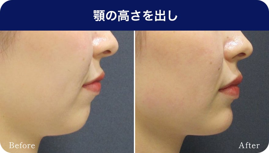 顎の高さを出し【画像】