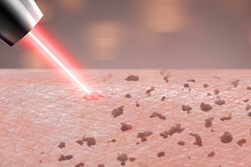 レーザートーニング照射