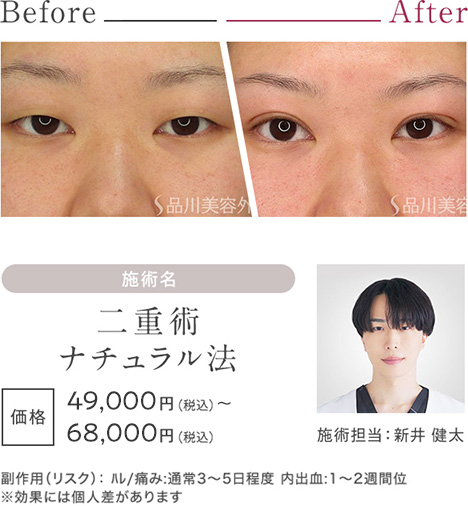 二重術ナチュラル法