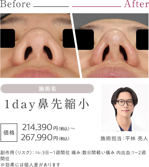 1day鼻先縮小ハイパー