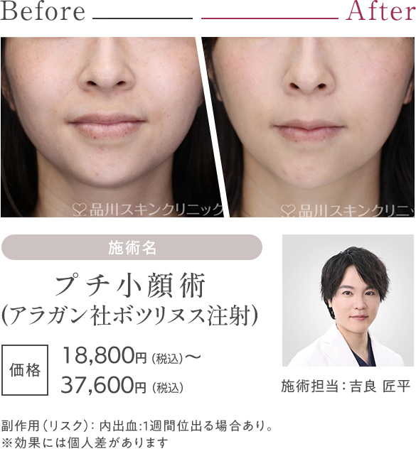 プチ小顔術（アラガン社ボツリヌス注射）