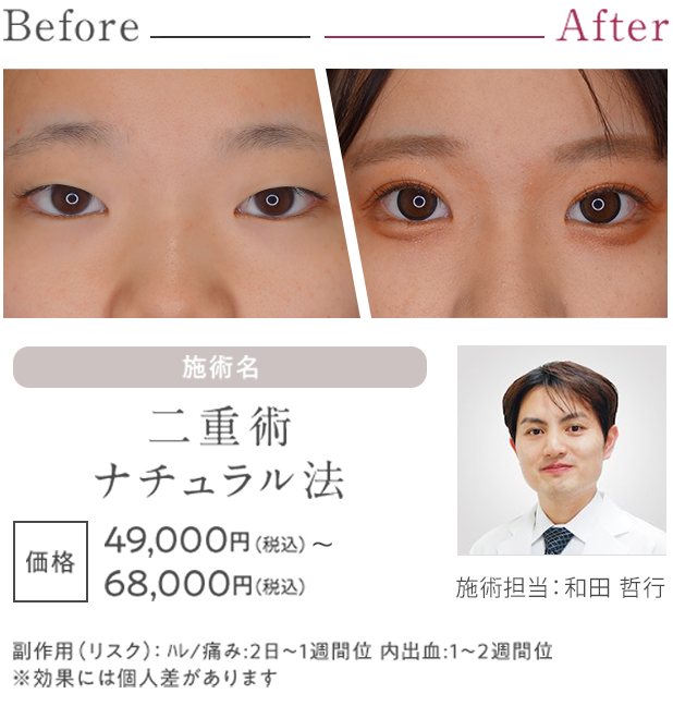 二重術ナチュラル法