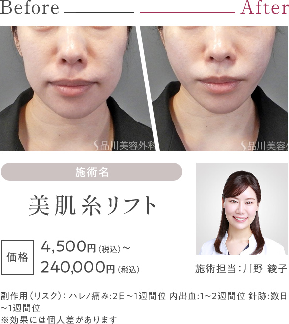 美肌糸リフト