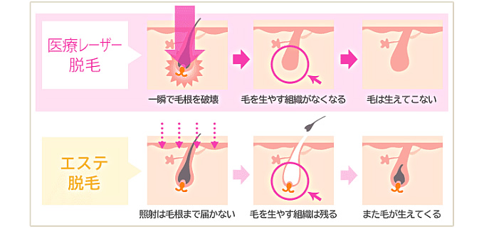 医療用レーザー脱毛とエステ脱毛の違い