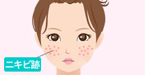 ニキビ跡を消したい！