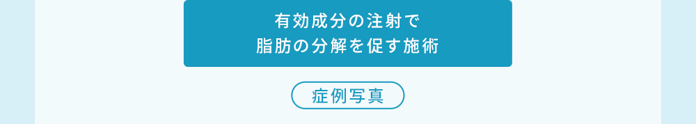 有効成分の注射で脂肪の分解を促す施術 症例写真