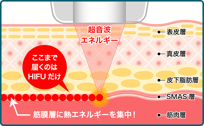 超音波エネルギーを皮膚の深層に集中照射→肌の表面はダメージを受けない→皮膚のたるみの根本治療 内側から引き締め リフトアップ シワ改善