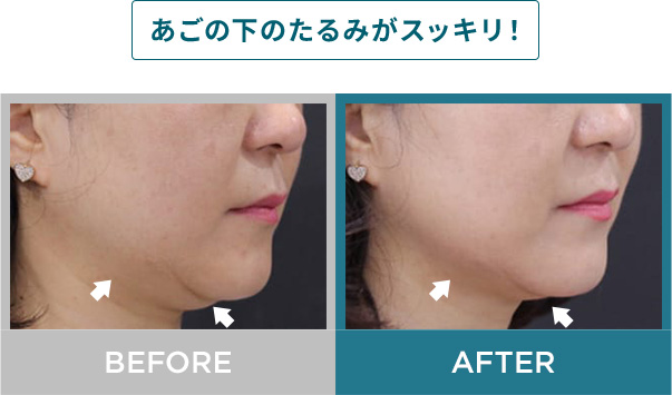 あごの下のたるみがスッキリ！