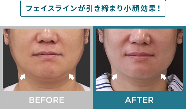 フェイスラインが引き締まり小顔効果！