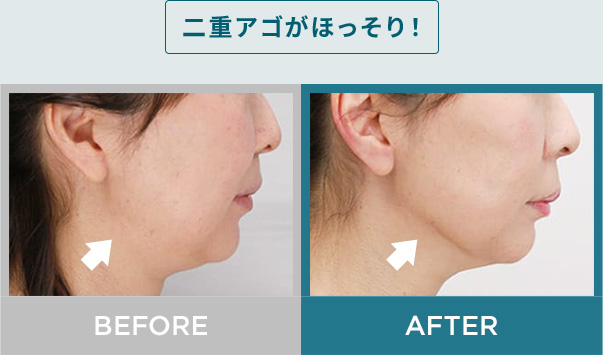 二重アゴがほっそり！