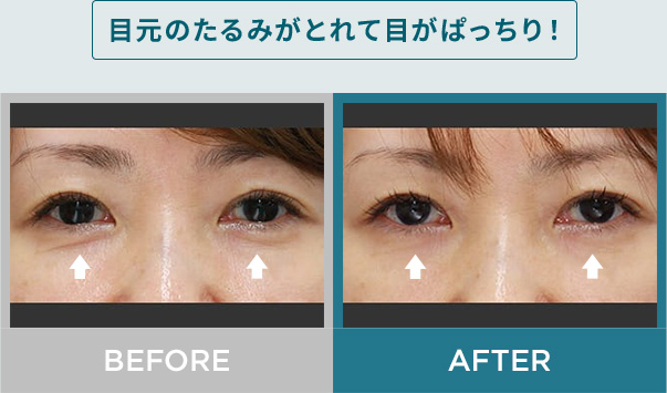 目元のたるみがとれて目がぱっちり！