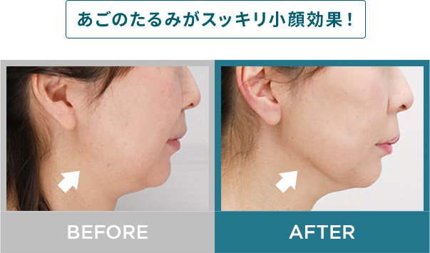 あごのたるみがスッキリ小顔効果！