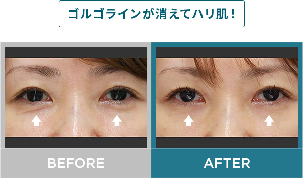 ゴルゴラインが消えてハリ肌！