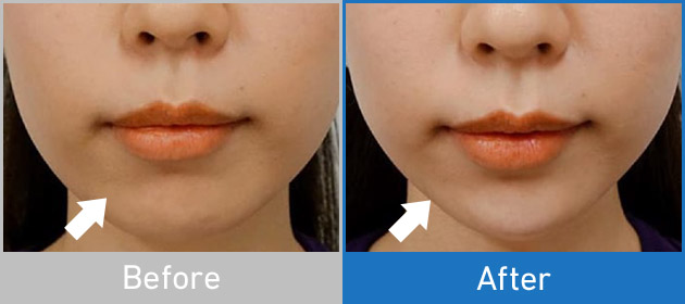 Before After