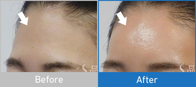 Before After