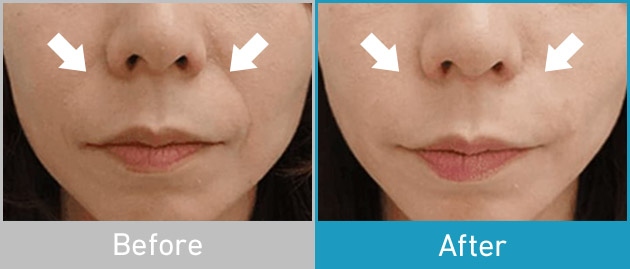 Before After