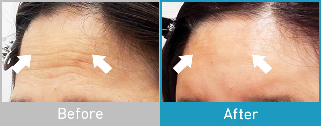 Before After