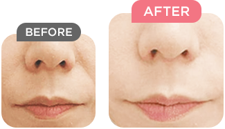 Before After