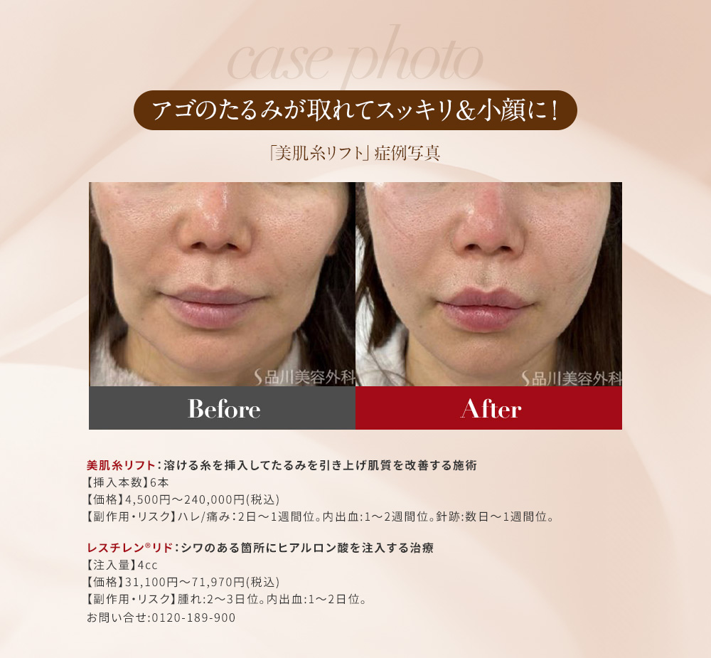 case photo アゴのたるみが取れてスッキリ＆小顔に！ 「美肌糸リフト」症例写真