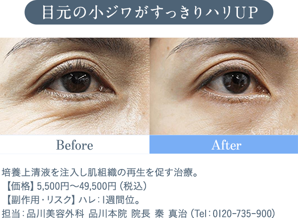 目元の小ジワがすっきりハリUP 培養上清液を注入し肌組織の再生を促す治療。【価格】5,500円～49,500円（税込）　【副作用・リスク】ハレ：1週間位。担当：品川美容外科 品川本院 院長 秦 真治（Tel：0120-735-900）
